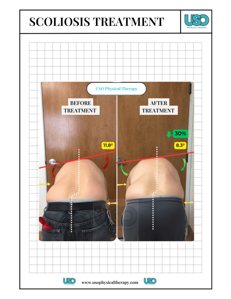Scoliosis treatment